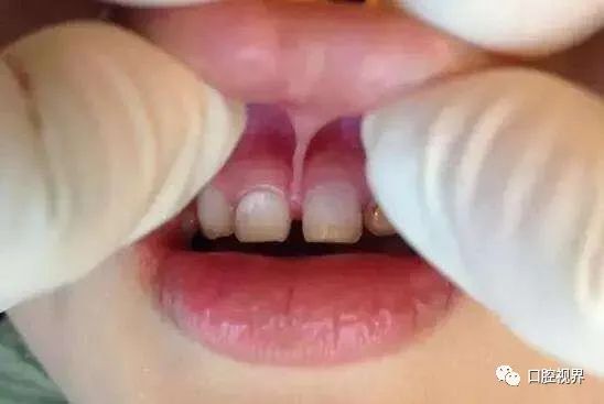 听说牙缝太大难看又露财，您给看看这牙缝还有救吗？