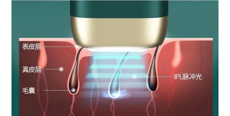 j-style脱毛仪测评,j-style美容仪好用吗