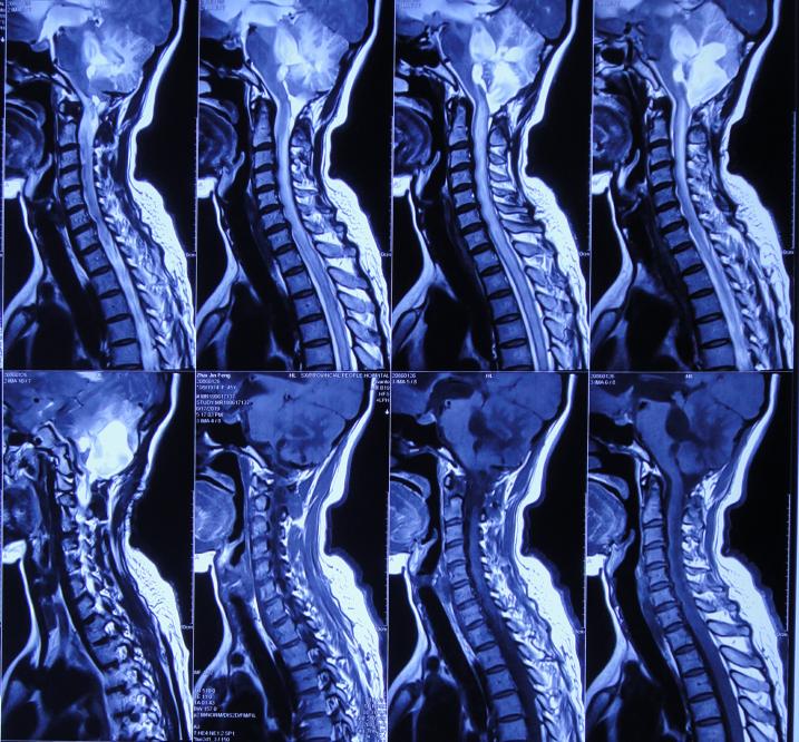 脑出血后脑积水会造成意识不清吗,脑出血后脑积水发高烧危险期多久