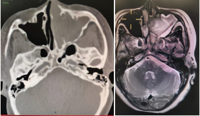 「掌健识」鼻出血的那些事