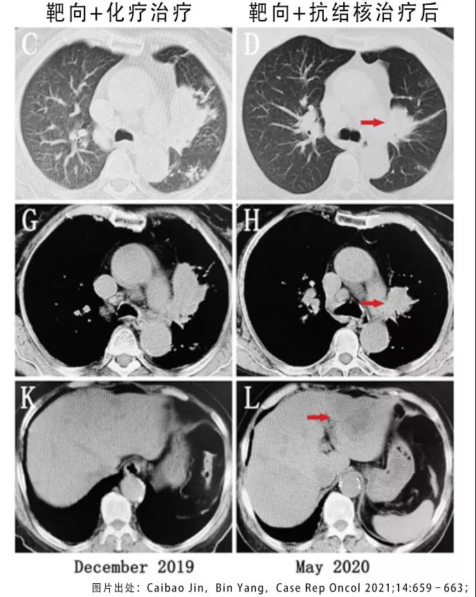 肺癌靶向药病灶减小癌胚抗原升高,肺癌吃靶向药病灶没了算治愈了吗