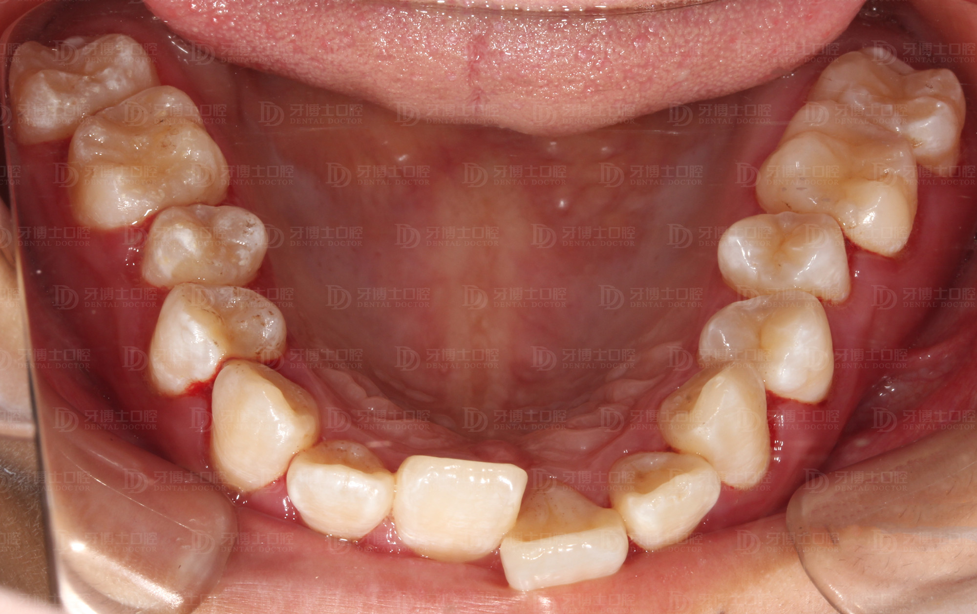 八岁孩子牙齿不齐用什么矫正,十岁小孩牙齿不齐需要矫正吗