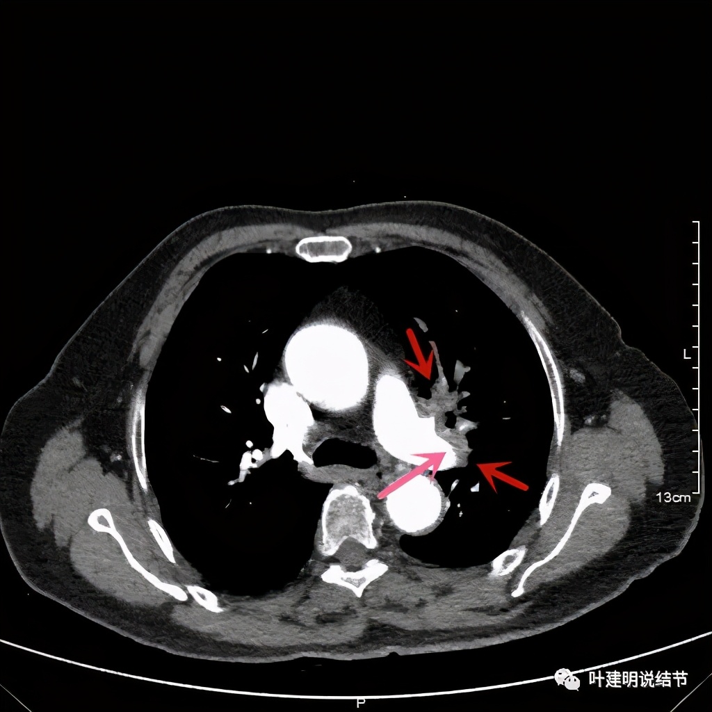 卡瑞利珠单抗治疗肺鳞癌有用吗,特瑞普利单抗对鳞癌治疗有效吗