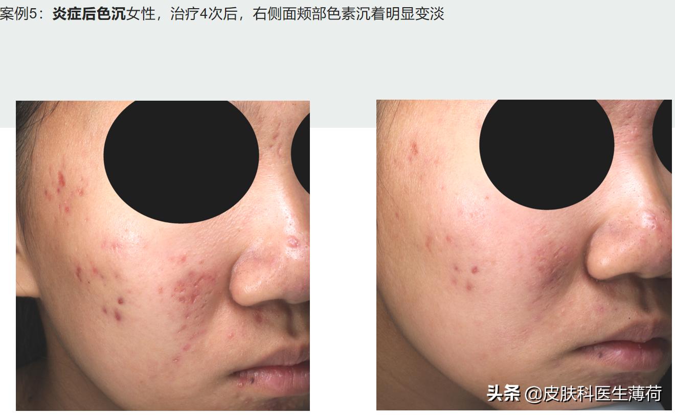 修复痘坑水杨酸果酸哪种好用,刷酸去闭口水杨酸敏感肌