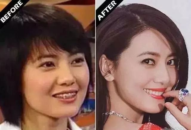 赵薇牙齿做了烤瓷牙吗,吴宣仪牙齿烤瓷牙