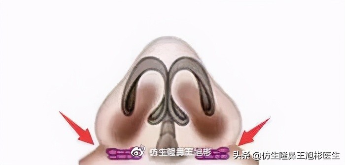 隆鼻鼻型科普,鼻基底凹陷隆鼻可以改善吗