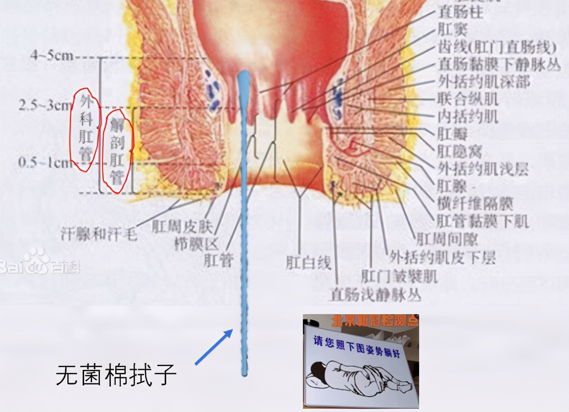 菊促不安？做完肛拭子变成企鹅步？其中酸爽推测，助你掌控全菊
