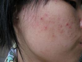 中药熏蒸熏完两次的效果,中药熏蒸吸入疗法