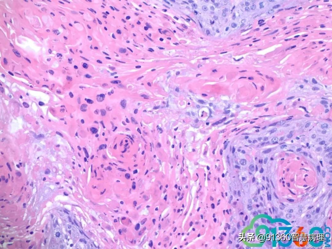 病理宫颈活检lsil是什么意思,宫颈病理检查与tct检查的区别