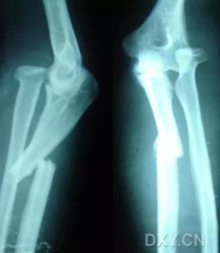 几种严重骨折医学名称,常见的骨折有哪些名称