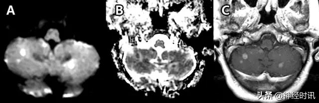 脑卒中病历诊断书图片,脑卒中影像判断技巧图解电子版