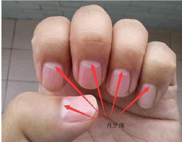 指甲有竖条纹是大病的前兆吗,指甲出现褐色竖纹代表什么病