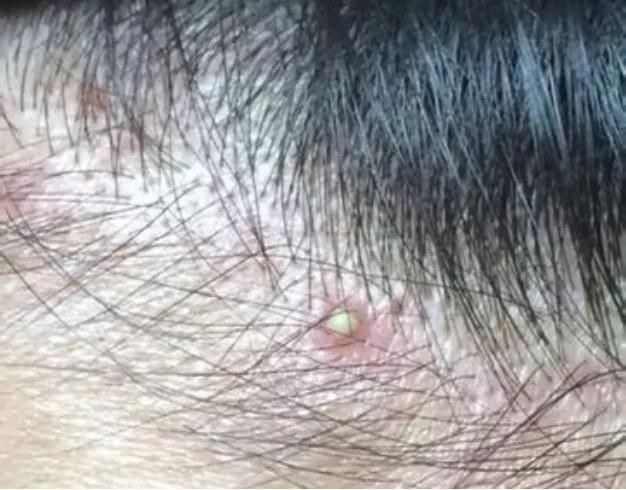 头皮和脸上长痘痘,小孩头皮上长痘痘