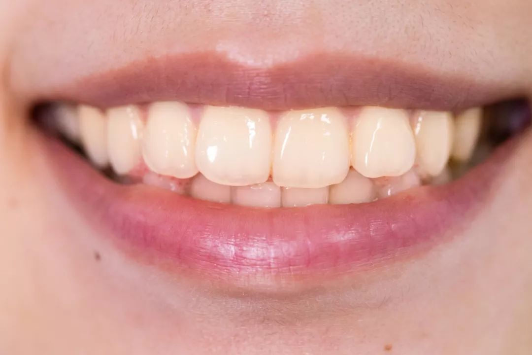 最好用的洗大黄牙的牙膏,马卡龙牙膏去牙垢方法