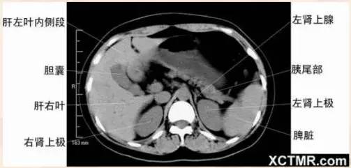 女性盆腔ct断层解剖结构图,女性盆腔脏器ct解剖