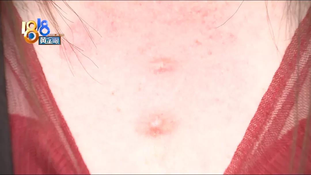 点痣以后长出来白色凸起疙瘩,点痣后又长出来一个小点