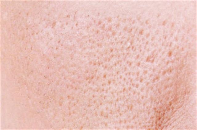 毛孔粗大如何改善最有效的方法,毛孔粗大目前最有效的方法