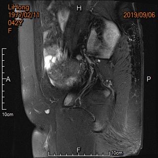 子宫腺肌病保守治疗无效怎么办?