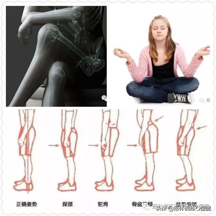 矫正O型腿的动作,o型腿矫正正确方法