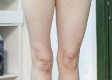 腰椎间盘突出会引起哪里肌肉萎缩,腰椎狭窄突出会导致腿部肌肉萎缩