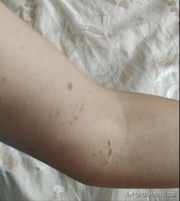 银屑病抗争经历,我与鱼鳞病的抗争