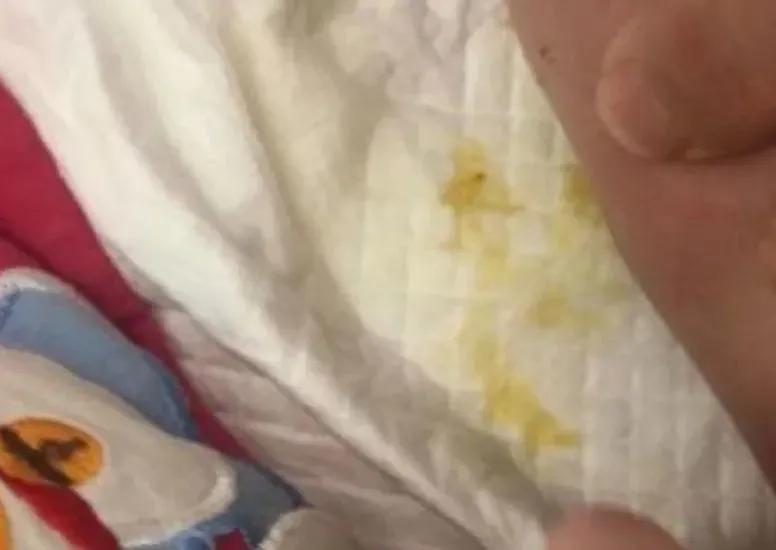 宝宝拉稀导致的红屁股擦什么,宝宝一直拉稀屁股很红怎么办