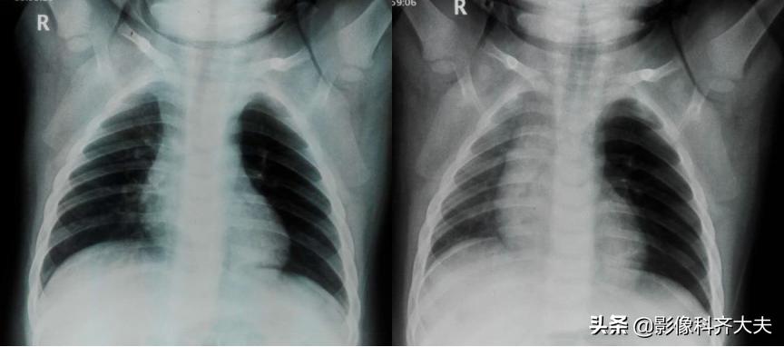 小儿气管镜怎么检查,小儿ct检查全过程视频