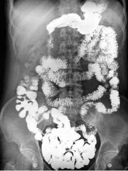 造影剂恶心持续多久,造影后造影剂没有及时排出后遗症