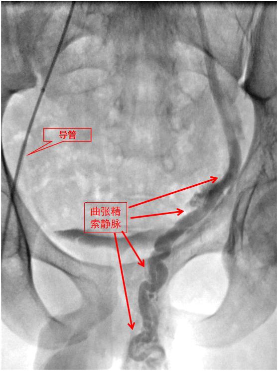 介入别人婚姻导致其怀孕犯法吗,介入科对生育的影响
