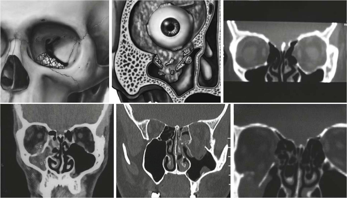 眼眶骨折后什么情况需要复查,眼眶骨折只能从ct上看出来吗