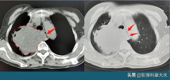 肺癌晚期脑转移用靶向药能活多久,肺癌晚期靶向治疗一般能活多少年