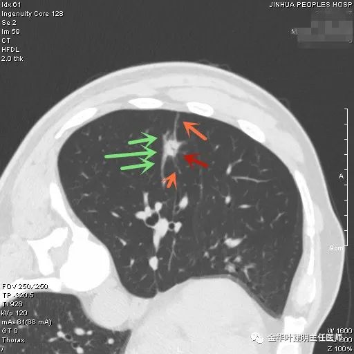 叶建明谈实性结节,叶建明肺实性良性结节会变癌症吗