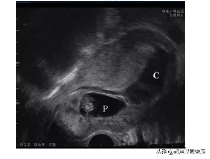 剖宫产疤痕妊娠几率,剖宫产疤痕妊娠及其护理