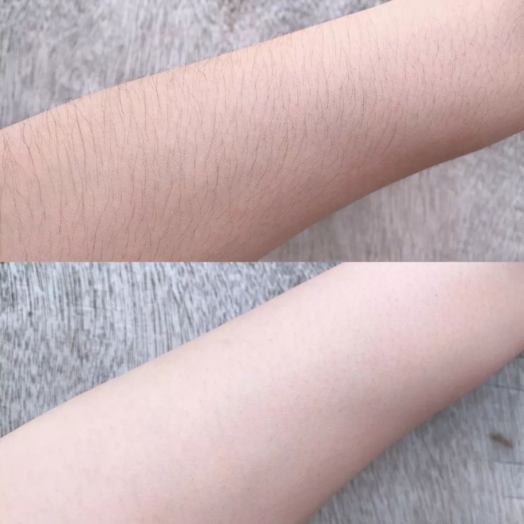 世界公认脱毛最有效的方法,目前最好的脱毛技术