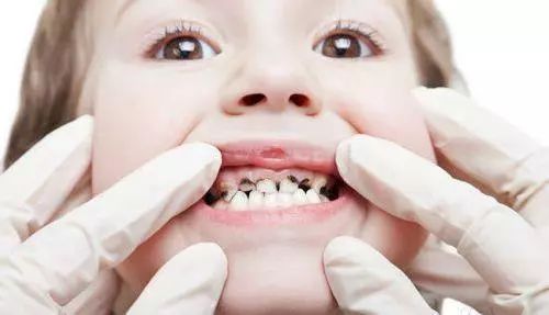 一岁孩子门牙奶瓶龋怎么办,两岁宝宝牙齿有奶瓶龋