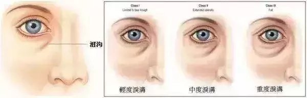 滤镜还是拯救不了眼袋,适合有眼袋的滤镜