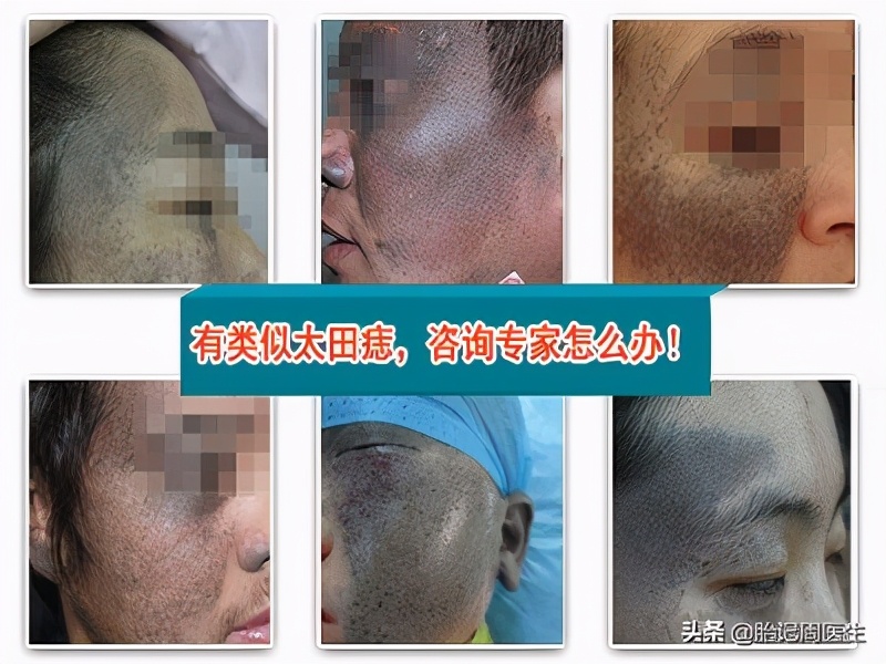 宝宝身上的青胎记几岁消除,宝宝青胎记长在腿上怎么去除