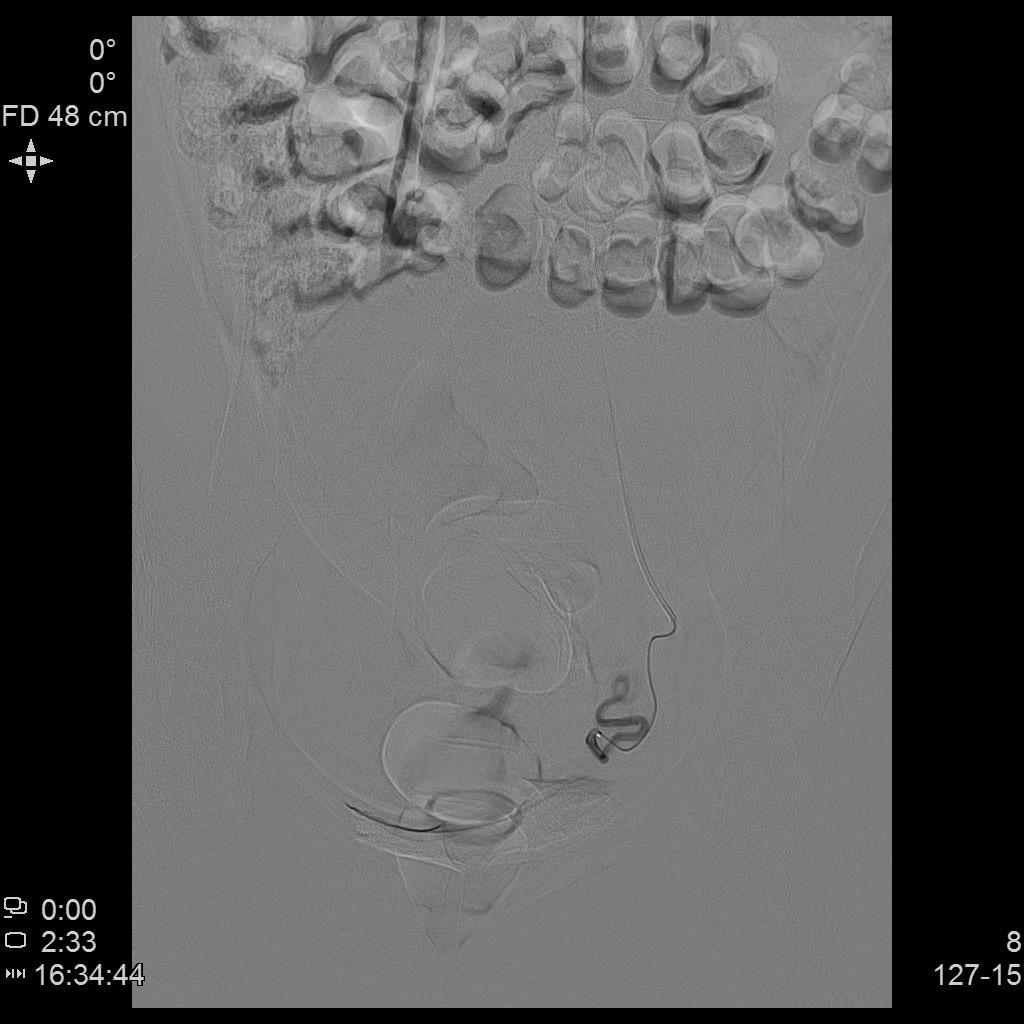 子宫肌瘤介入栓塞造影剂作用,子宫肌瘤介入栓塞有副作用吗