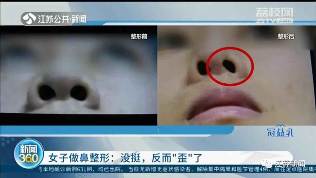 整容鼻子歪了真实案例,女子整容嘴变歪后来怎么样了