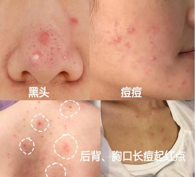清理黑头痘痘的治愈过程,祛痘痘痘印黑头用什么好
