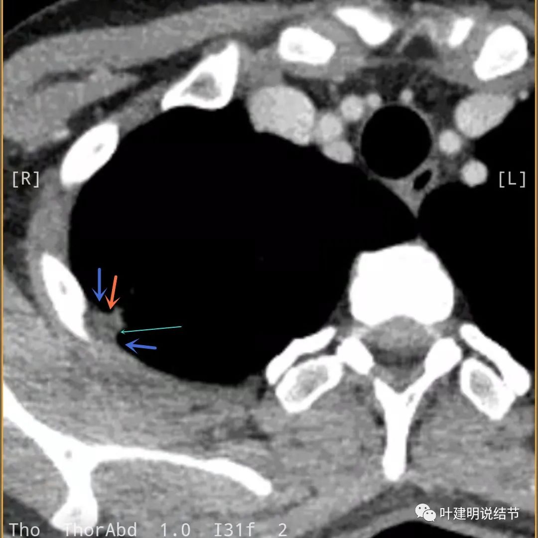 临床诊断孤立性肺结节,空洞型结节一般是什么性质