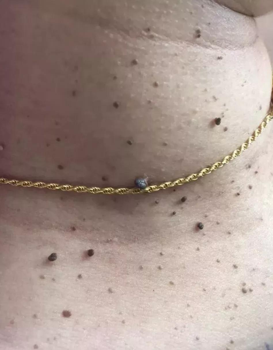 脸上长了像黑痣一样的东西,脸上长了像痘痘的东西是啥