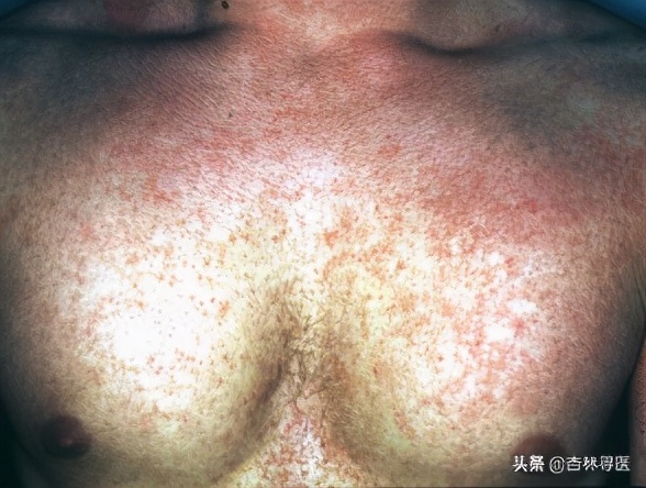 儿童嗓子发炎化脓快速解决方法,孩子喉咙发炎化脓怎么治疗最快