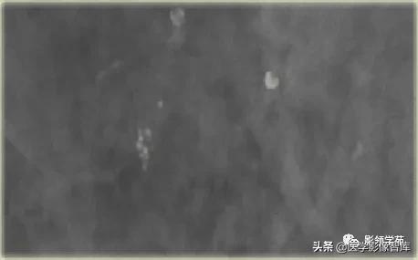 乳腺钙化怎么区分良性和恶性,乳腺钙化的诊断与分级