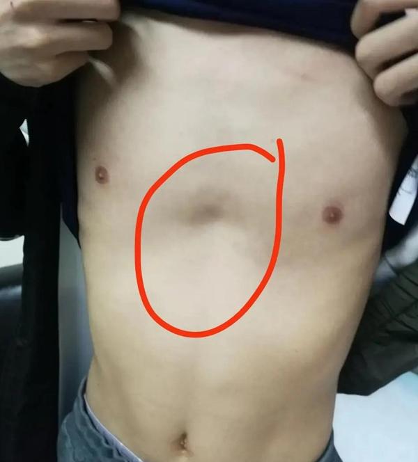 漏斗胸的治疗最好方法,漏斗胸保守治疗方法