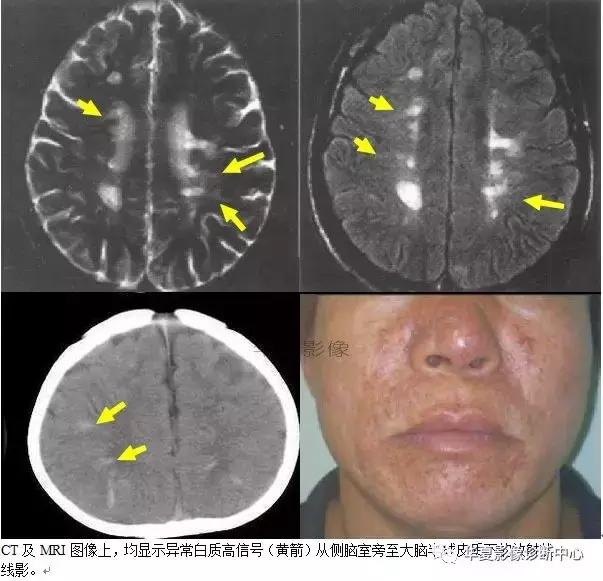 颅脑核磁影像解剖图谱,颅脑mr增强影像图片