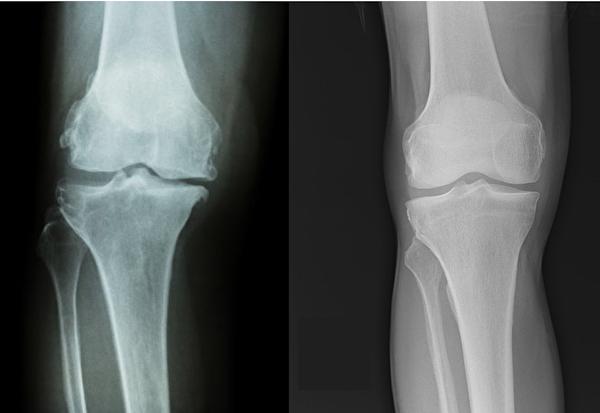 运动膝盖受伤会造成肌肉萎缩吗,运动导致膝盖受损能彻底根治吗