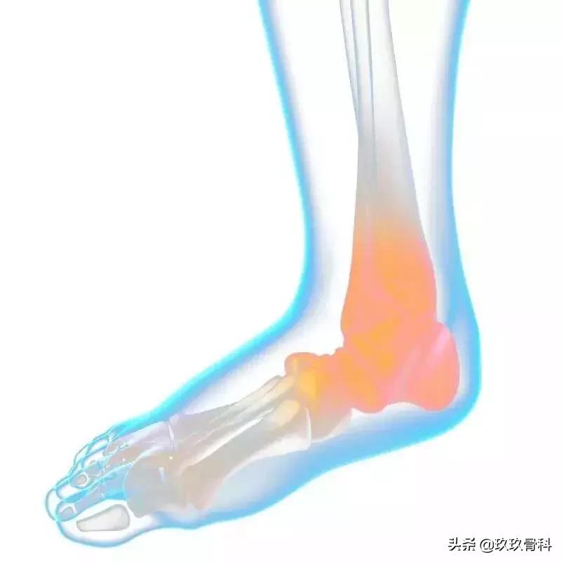 崴脚后遗症的三步恢复法,很多人的脚都崴伤