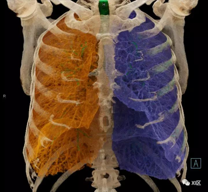 如此详细的肺部影像解剖，有点儿酷