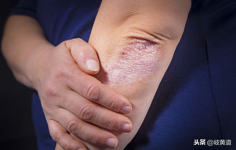 皮肤红色丘疹瘙痒,湿疹长小丘疹很严重吗